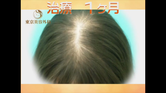 発毛治療のご相談、増えていますの記事動画
