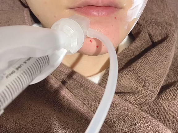 水光注射＋サーモン注射②の記事動画