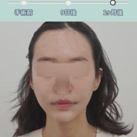 糸リフト、あごボトックス、エラボトックス症例動画の画像
