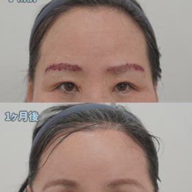 額縮小＆額挙上症例動画の画像