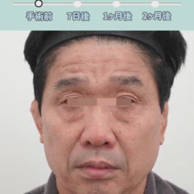 額挙上+顔面挙上レポの画像