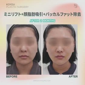 ミニリフト、顔脂肪吸引、バッカルファット除去症例動画の画像
