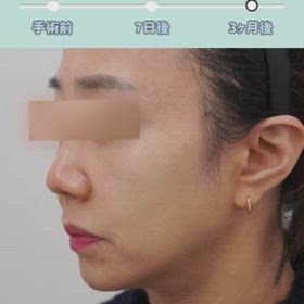 ミニリフト、糸リフト、上眼瞼症例動画の画像