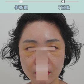 額挙上、ミニリフト、糸リフト症例動画の画像