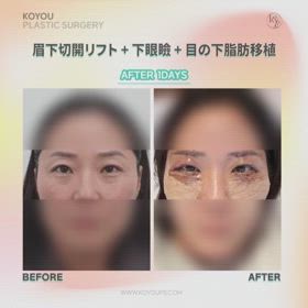 眉下切開リフト、下眼瞼、目の下脂肪移植症例動画の画像