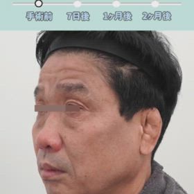 額挙上、顔面挙上症例動画の画像
