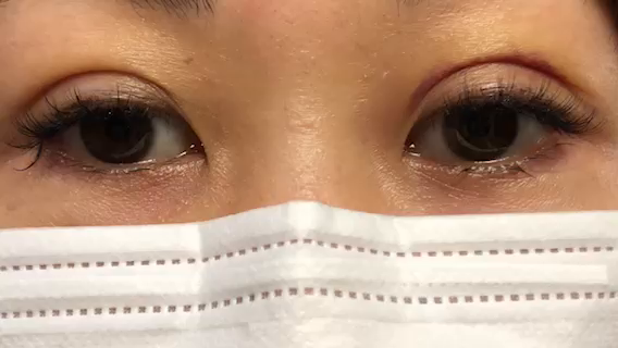 二重術5日後、ネット検索で負のスパイラルにの記事動画