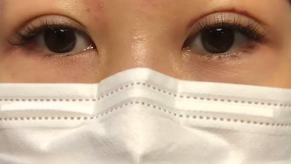 二重術9日後の記事動画