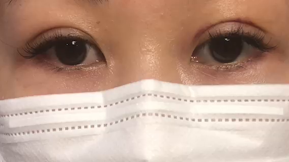 二重術7日後、無事旅行終了の記事動画