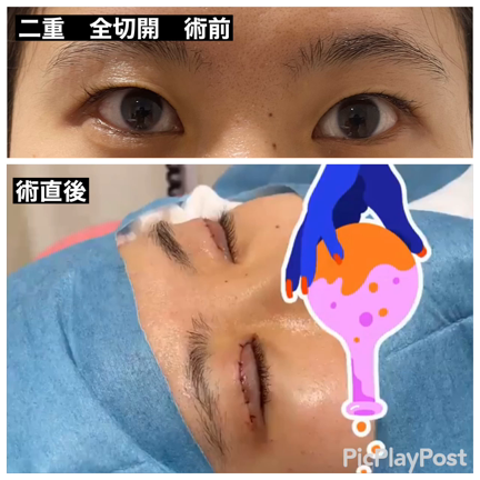 帰ってきた「二重全切開」の記事動画