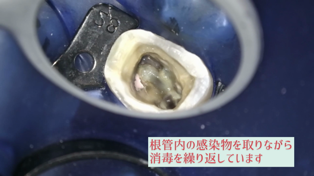 兵庫県から通院されている患者様の根管治療についての記事動画