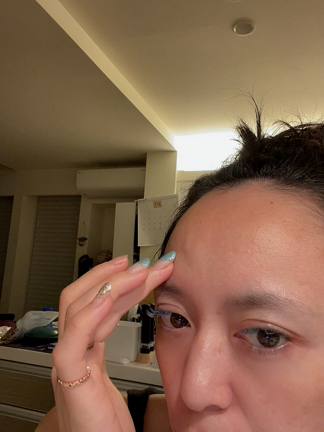 事件！突然おでこが陥没からのヒアルロン酸の記事動画