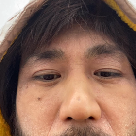 心眼ばれ、の画像