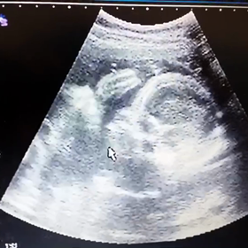 ダウン症の娘を妊娠した時　　　　妊娠初期の画像