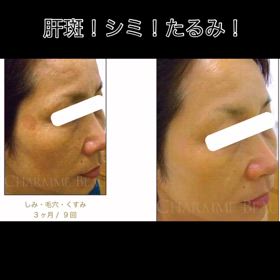 本気で肝斑改善の画像