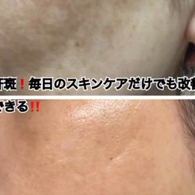 レーザーに頼 らなくても肝斑改善の画像