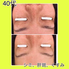 肝斑改善の画像