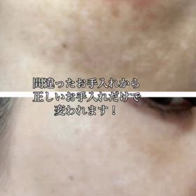 パーソナルケアで肝斑改善の画像