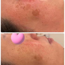 敏感肌でも 肝斑薄くの画像