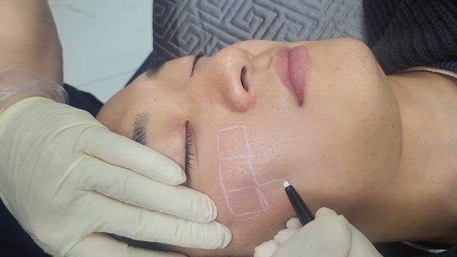 たるみ・シワ・ニキビ跡や傷跡治療に効果的なSRSレーザーとは？の記事動画