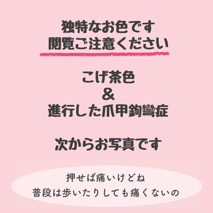 こげ茶色＆進行した爪甲鉤彎症（閲覧ご注意ください）の記事動画