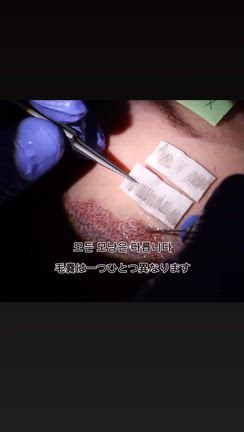 「同じ植毛」でも仕上がりが違うのはなぜ？ 形成外科専門医が毛嚢を直接選別する理由の記事動画
