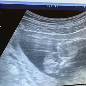 12ｗ2ｄ妊婦検診の画像