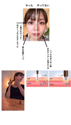【no整形】で小顔になれた美顔器 フェイスポインター corefitの記事動画