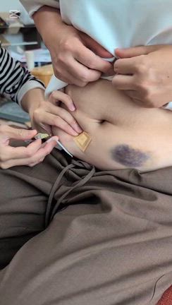 【動画有り】看護師の義妹が教えてくれた、ヘパリンカルシウム皮下注の刺し方講座！の記事動画