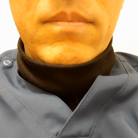 耳下腺癌　重粒子線治療で顔面神経麻痺回復中！の画像