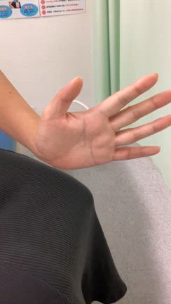 【剥離骨折　諦めていたバレーボールに復帰】　自由が丘　おかじま接骨院　骨折　スポーツの記事動画