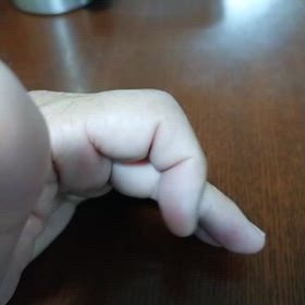その後の突き指の画像