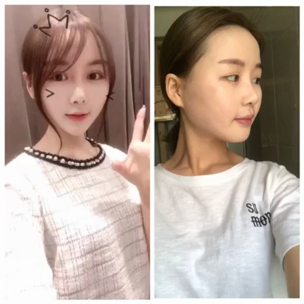 ♥POP韓国整形／美容整形♥目頭切開手術の前後、 目頭切開の傷跡を残らないようにするコツとは？の記事動画