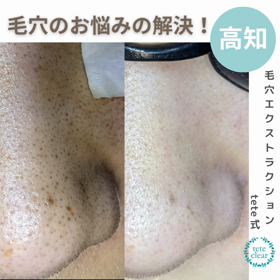 毛穴エクストラクションの画像