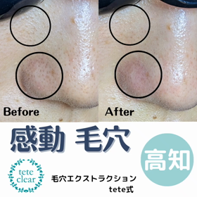 毛穴エクストラクションの画像