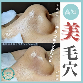毛穴エクストラクションの画像