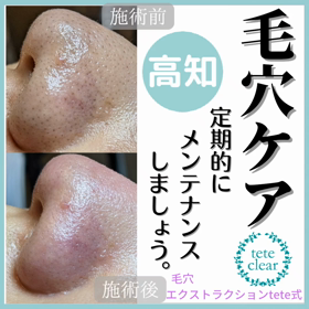 毛穴エクストラクションの画像
