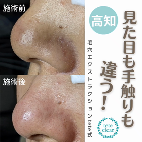 毛穴エクストラクションの画像