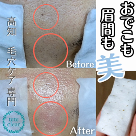 眉間のあれも  劇的の画像