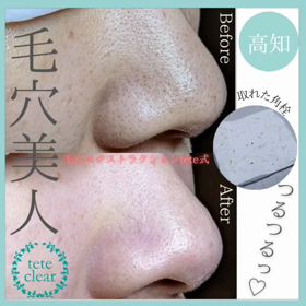 毛穴エクストラクションの画像