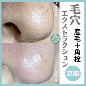 毛穴エクストラクションの画像