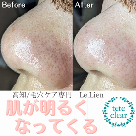 毛穴エクストラクションの画像