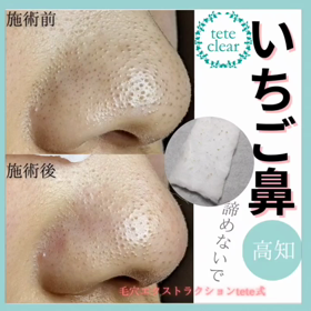 毛穴エクストラクションの画像
