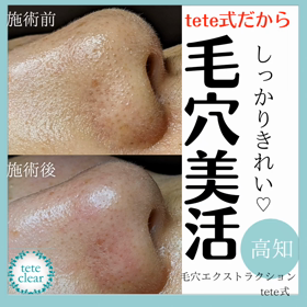 毛穴エクストラクションの画像