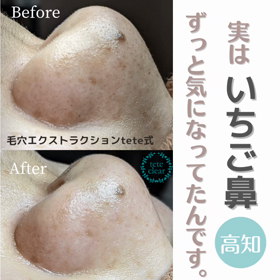 毛穴エクストラクションの画像