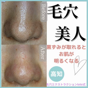 毛穴エクストラクションの画像