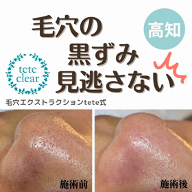 毛穴エクストラクションの画像