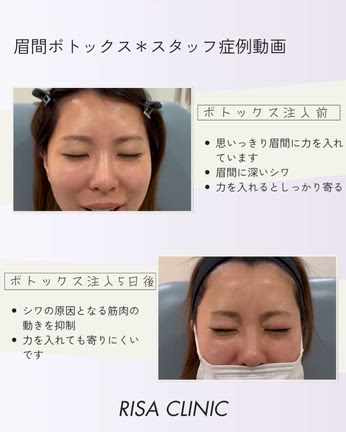 スタッフが体験☆眉間ボトックスのご紹介♪の記事動画