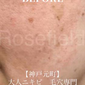 神戸元町エステ｜40代の毛穴・シミ改善 RFピールで肌質改善の画像