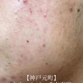 神戸元町エステ｜大人ニキビ・毛穴改善 RFピール症例の画像